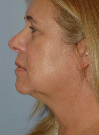 Laser Lift neck and jawline 1497256