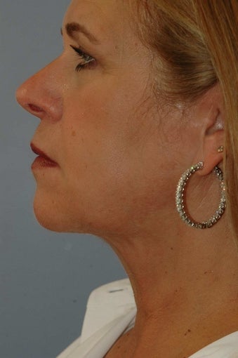 Laser Lift neck and jawline 1497256