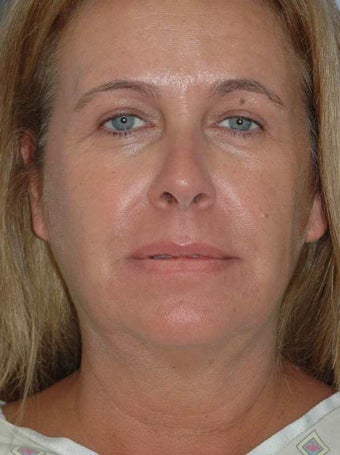 Laser Lift neck and jawline before 1497256