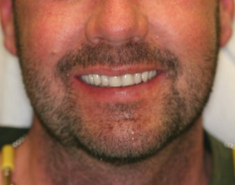 32 year old male treated with All-on-4 Dental Implant Procedure after 1053457