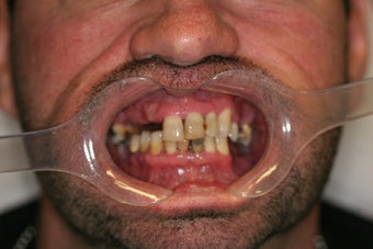 32 year old male treated with All-on-4 Dental Implant Procedure before 1053457