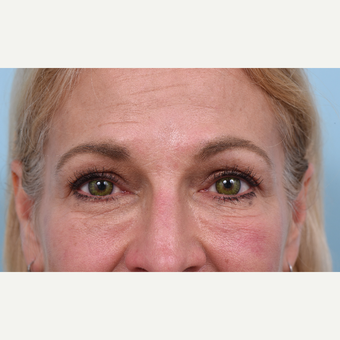 55 year old woman treated with Liquid Facelift after 3610780