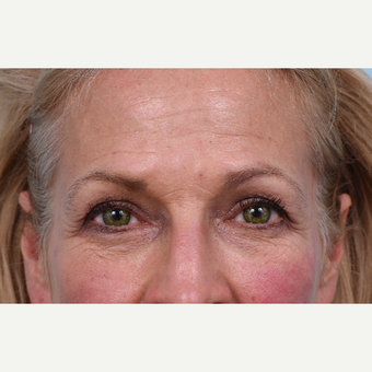 55 year old woman treated with Liquid Facelift before 3610780