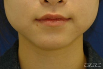 Botox Masseter Reduction for Masseter Hypertrophy and Bruxism (Teeth Grinding) before 1499639
