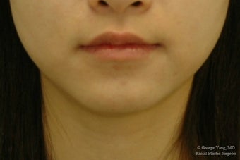 Botox Masseter Reduction for Masseter Hypertrophy and Bruxism (Teeth Grinding) after 1499639