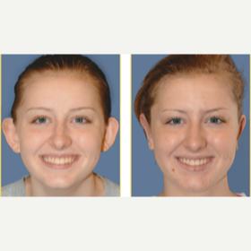 17 or under year old woman treated with Ear Surgery before 3749829