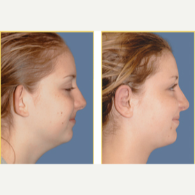 17 or under year old woman treated with Ear Surgery after 3749829