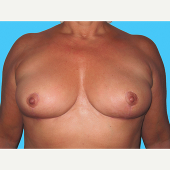 Breast Implant Removal after 3809855