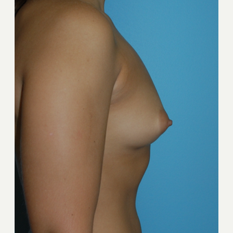 23 year old woman treated with 375 cc MPP silicone and size change from B to D cup before 3208115