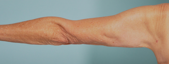 SmartLipo Liposuction of Arms after 275080