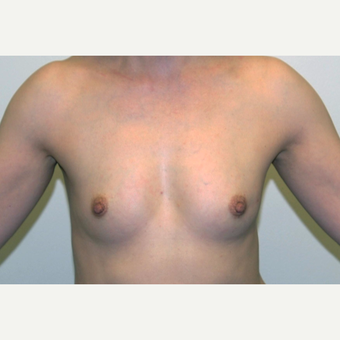 45-54 year old woman treated with Breast Augmentation before 3377503