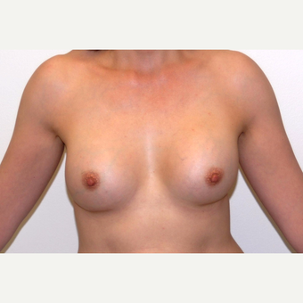 45-54 year old woman treated with Breast Augmentation after 3377503
