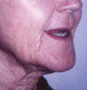 55-64 year old woman treated with Mini Lift before 3758357