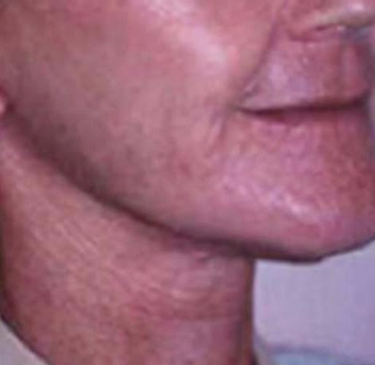 55-64 year old woman treated with Mini Lift after 3758357
