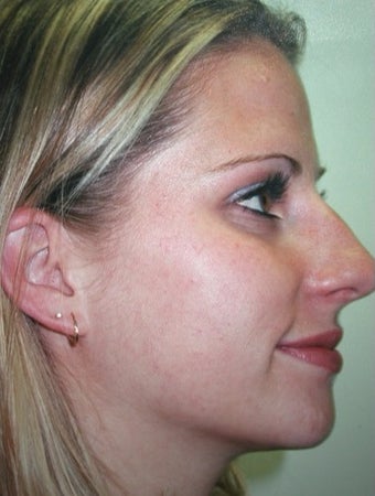 35-44 year old woman treated with Acne Treatment after 3263595