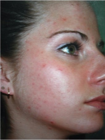 35-44 year old woman treated with Acne Treatment before 3263595