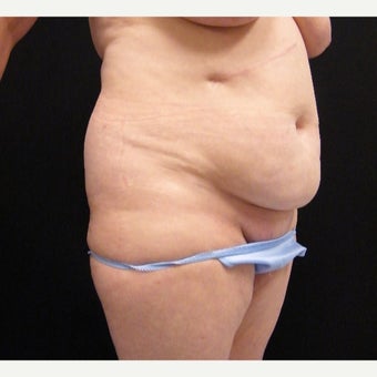 55-64 year old woman treated with Mini Tummy Tuck and SAFELipo of Flanks before 2366187