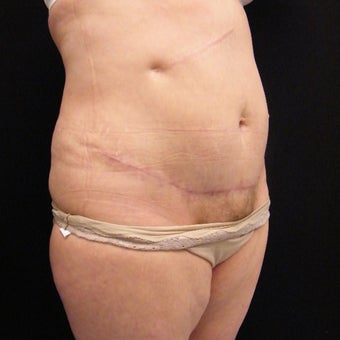 55-64 year old woman treated with Mini Tummy Tuck and SAFELipo of Flanks after 2366187