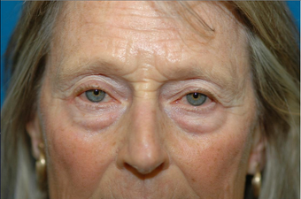 Lower lid bags removed via blepharoplasty before 932456