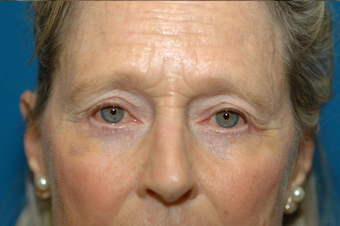 Lower lid bags removed via blepharoplasty after 932456