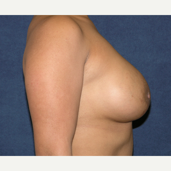 25-34 year old woman treated with Breast Implants after 3455129