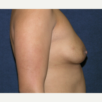 25-34 year old woman treated with Breast Implants before 3455129