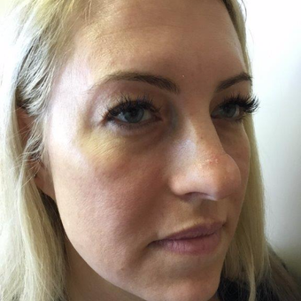35-44 year old woman treated with Rhinoplasty and upper eyelid blepharoplasty before 2954294