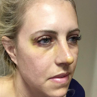35-44 year old woman treated with Rhinoplasty and upper eyelid blepharoplasty after 2954294