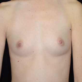 25-34 year old woman treated with Breast Augmentation before 3099100