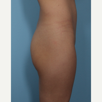 Buttock Augmentation with implants, natural results before 3487384