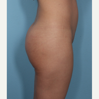 Buttock Augmentation with implants, natural results after 3487384