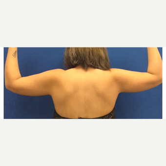 Liposuction of the Arms before 3072339