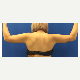 Liposuction of the Arms after 3072339