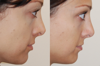 Non-Surgical Nose Job before 213045