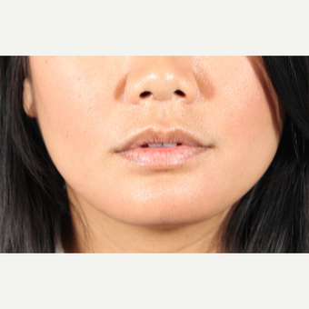 25-34 year old woman treated with Lip Augmentation before 3850948
