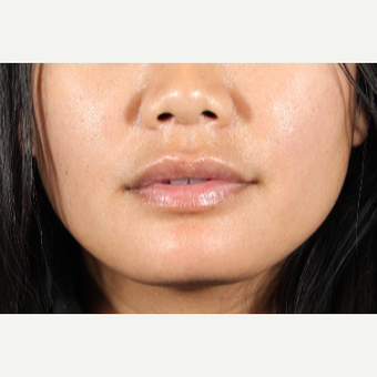 25-34 year old woman treated with Lip Augmentation after 3850948