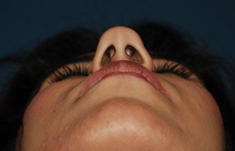 Rhinoplasty before 1266597