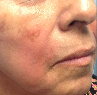 Female Patient Treated with Radiesse after 1044915