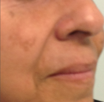 Female Patient Treated with Radiesse before 1044915