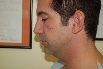 Pre and Post Radiesse Facial Shaping before 1016480