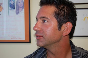 Pre and Post Radiesse Facial Shaping after 1016480