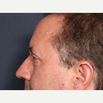55-64 year old man treated with Eyelid Surgery (view 2 of 2) after 3809848