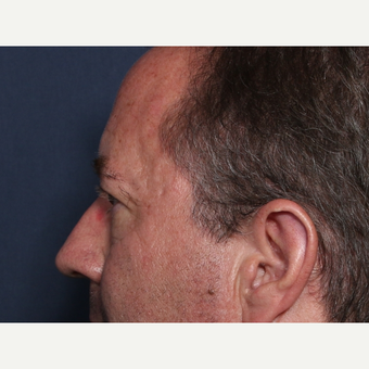 55-64 year old man treated with Eyelid Surgery (view 2 of 2) before 3809848