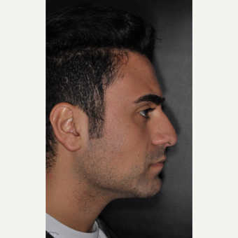 18-24 year old man treated with Septoplasty 6 weeks post-op before 3500171