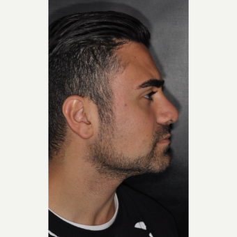 18-24 year old man treated with Septoplasty 6 weeks post-op after 3500171