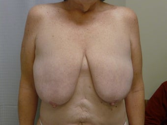 Ultimate Breast Lift - No implants - No Vertical Scar before 1181296