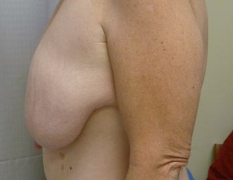Ultimate Breast Lift - No implants - No Vertical Scar 1181296