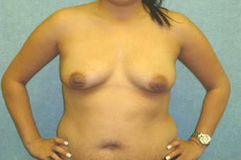 Fat transfer to the Breast - Natural Breast Augmentation before 420136