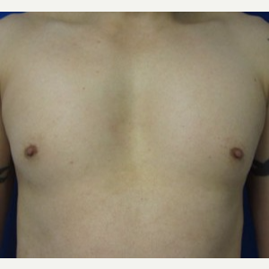 Pec Implants before 3164407