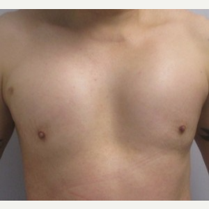 Pec Implants after 3164407